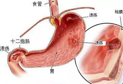 FOTIRC熱像儀應用于腔內潰瘍治療探針檢測